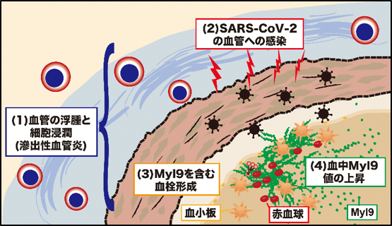 新型コロナウイルスの重症化説明